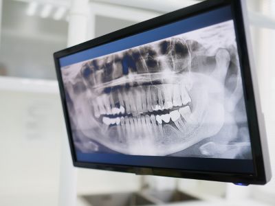 Digital Dental X-Rays