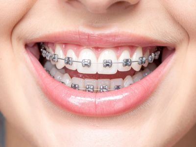 Orthodontics Braces